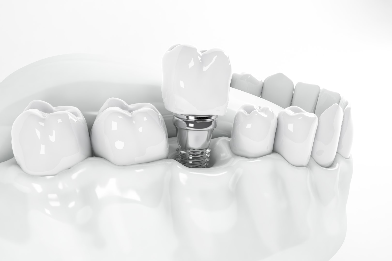 rezistenta implant dentar din zirconiu