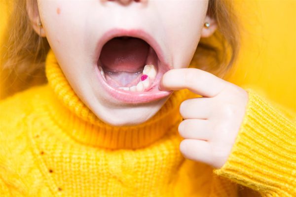 sigilare dentara la copii
