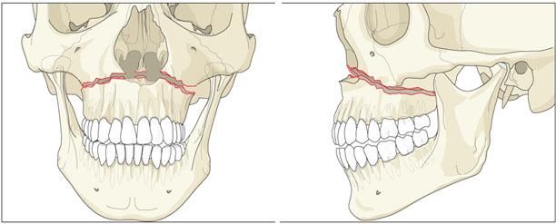 tratamentul articulațiilor maxilarului