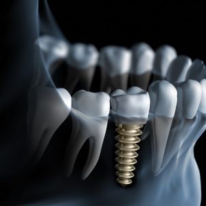 Implant denta bucuresti Zimmer