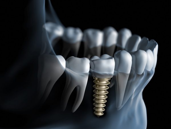 Implant denta bucuresti Zimmer