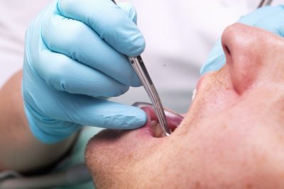 odontectomie extractie molar de minte