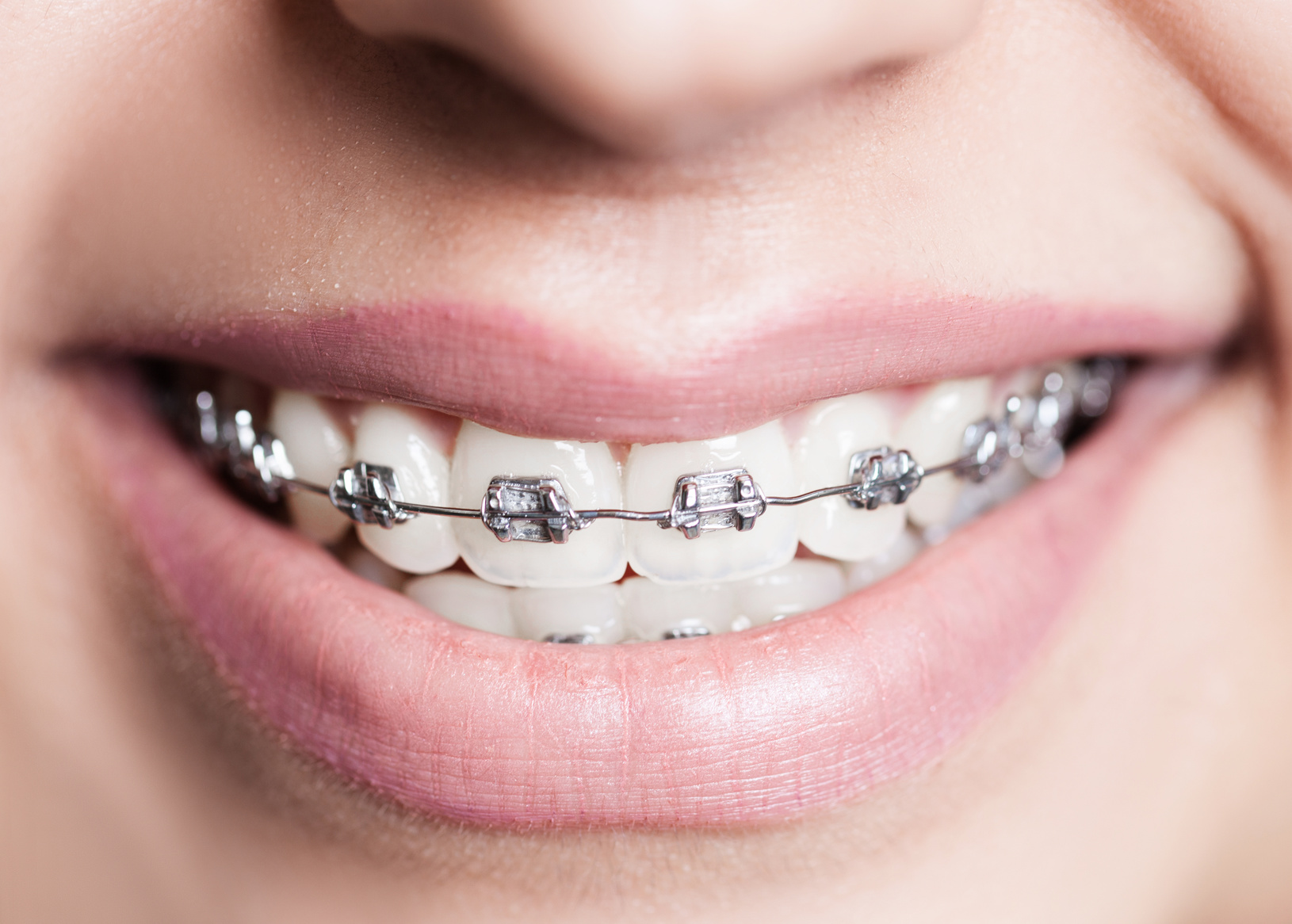 aparat-ortodontic-metalic-fix-abc-eurodent