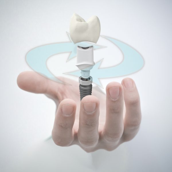 Igienizare implant dentar expus