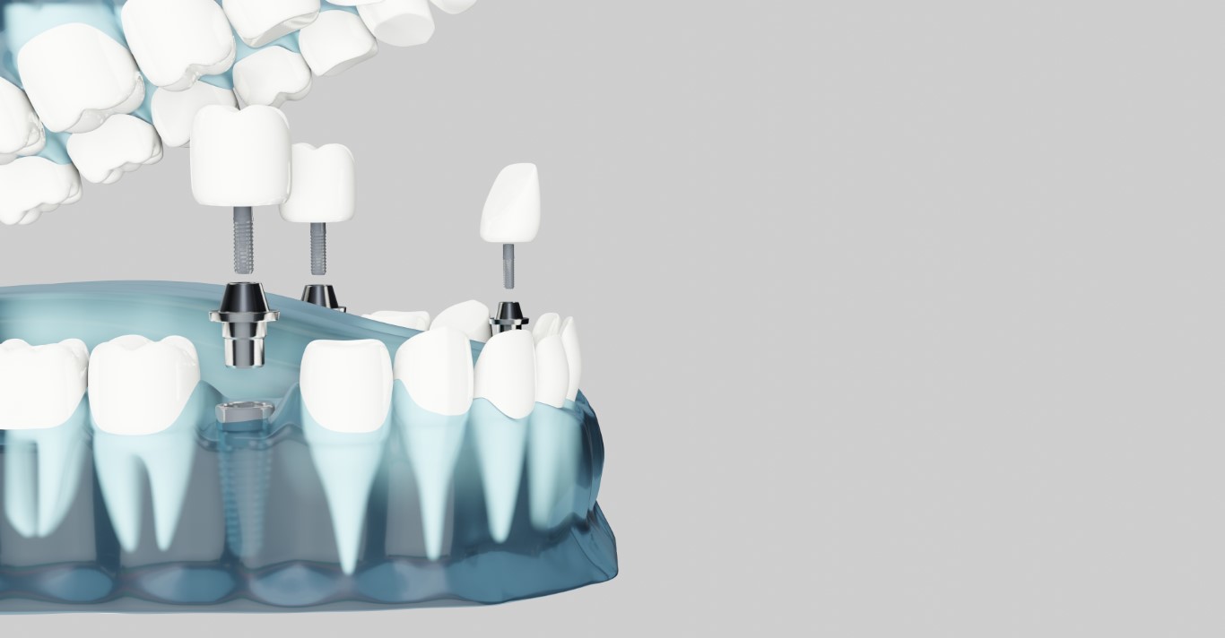 implant dentar dupa extractie