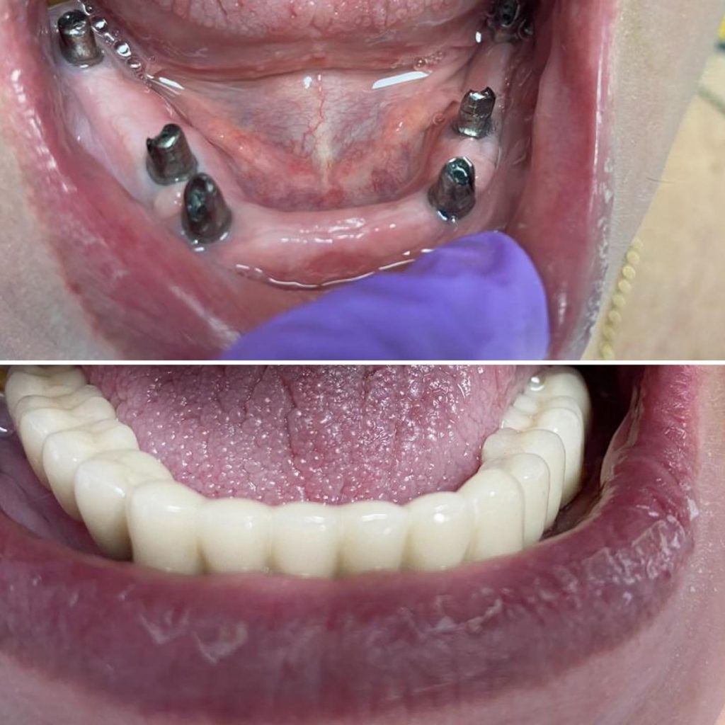 implant dentar final