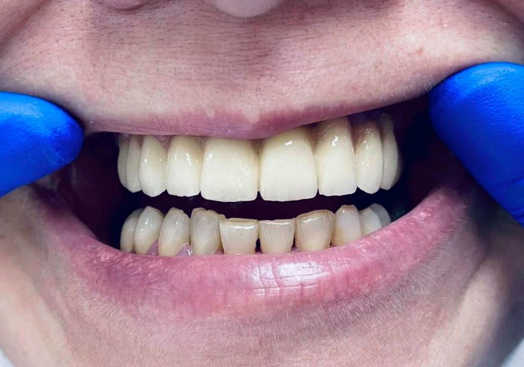 implant dentar mandibula