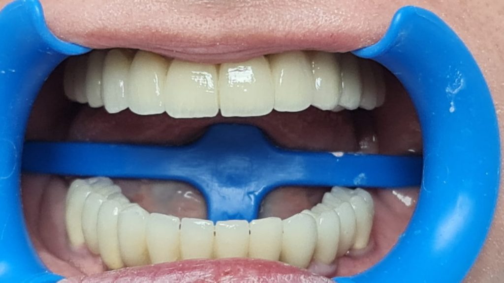 implant dentar pret