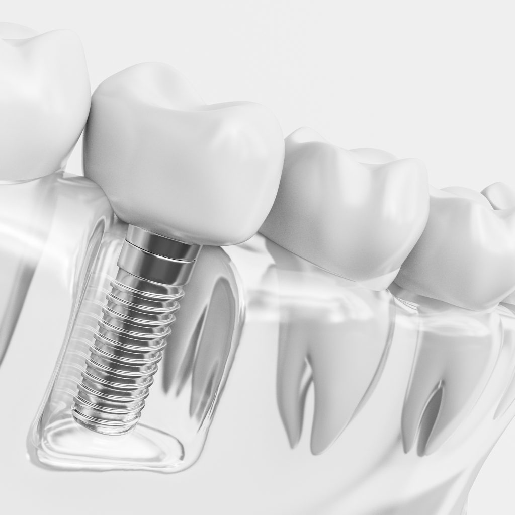 pachet implant dentar neo biotech