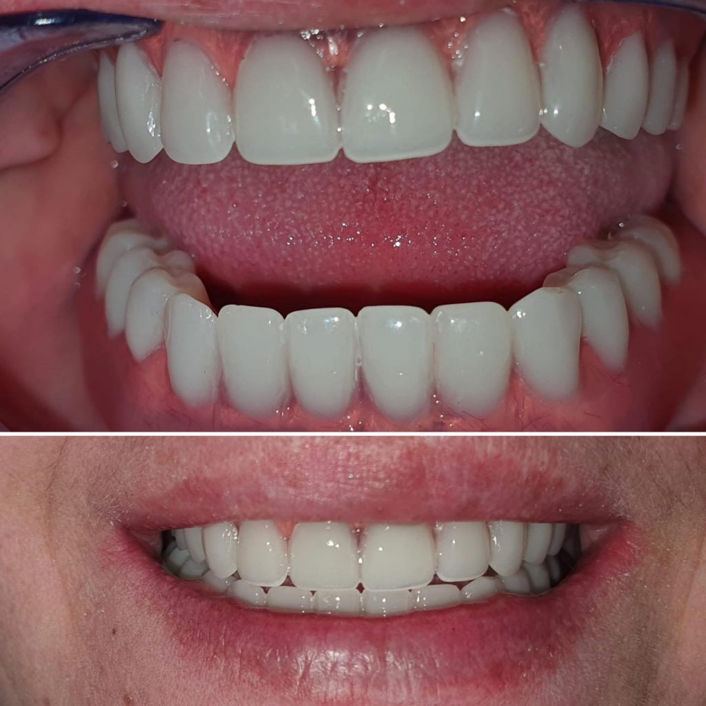 restaurare orala implant