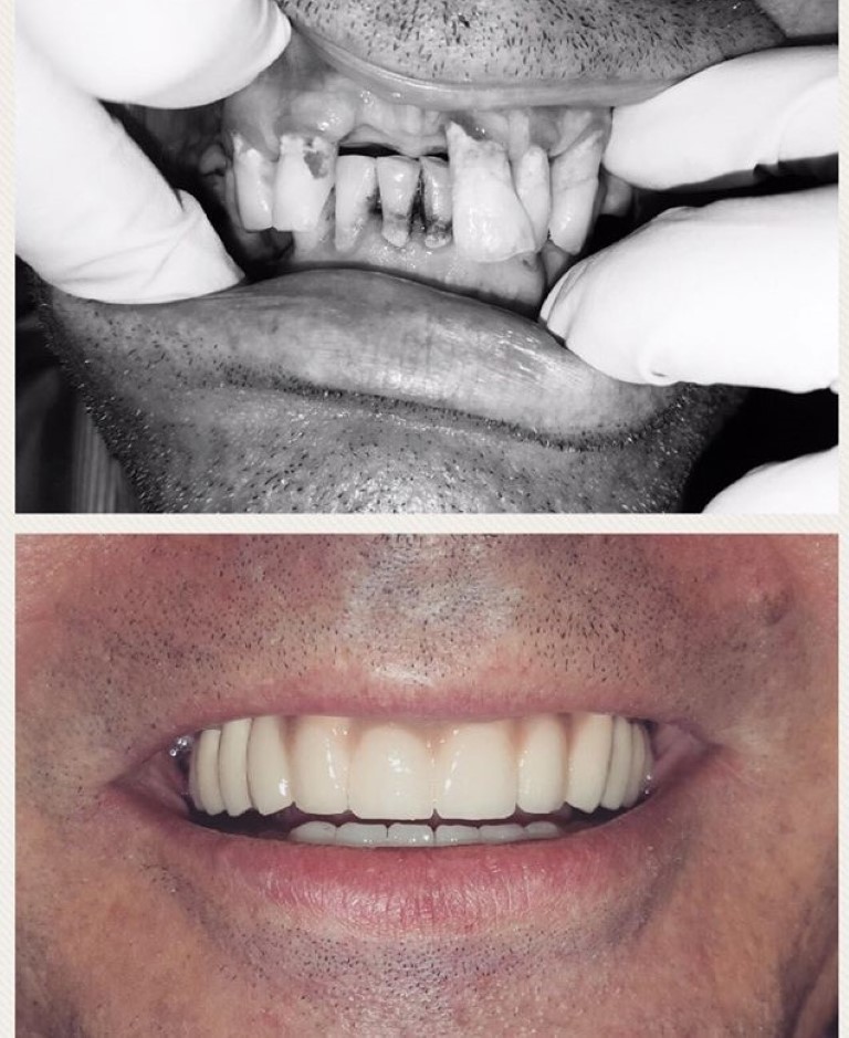 Durata implant dentar