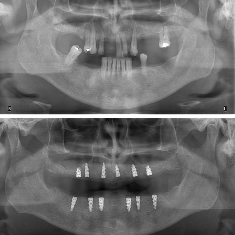 Implant dentar durata