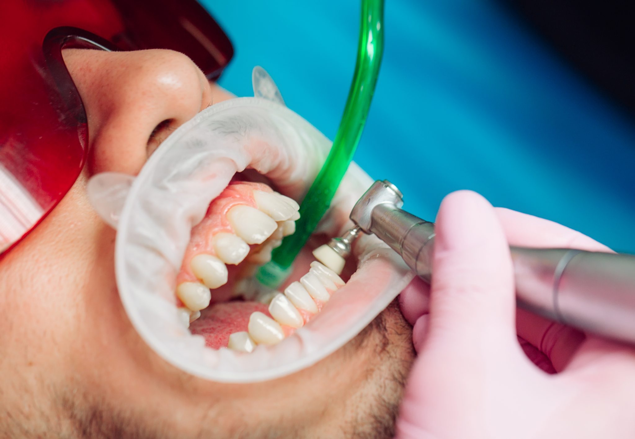 detartraj ultrasunete