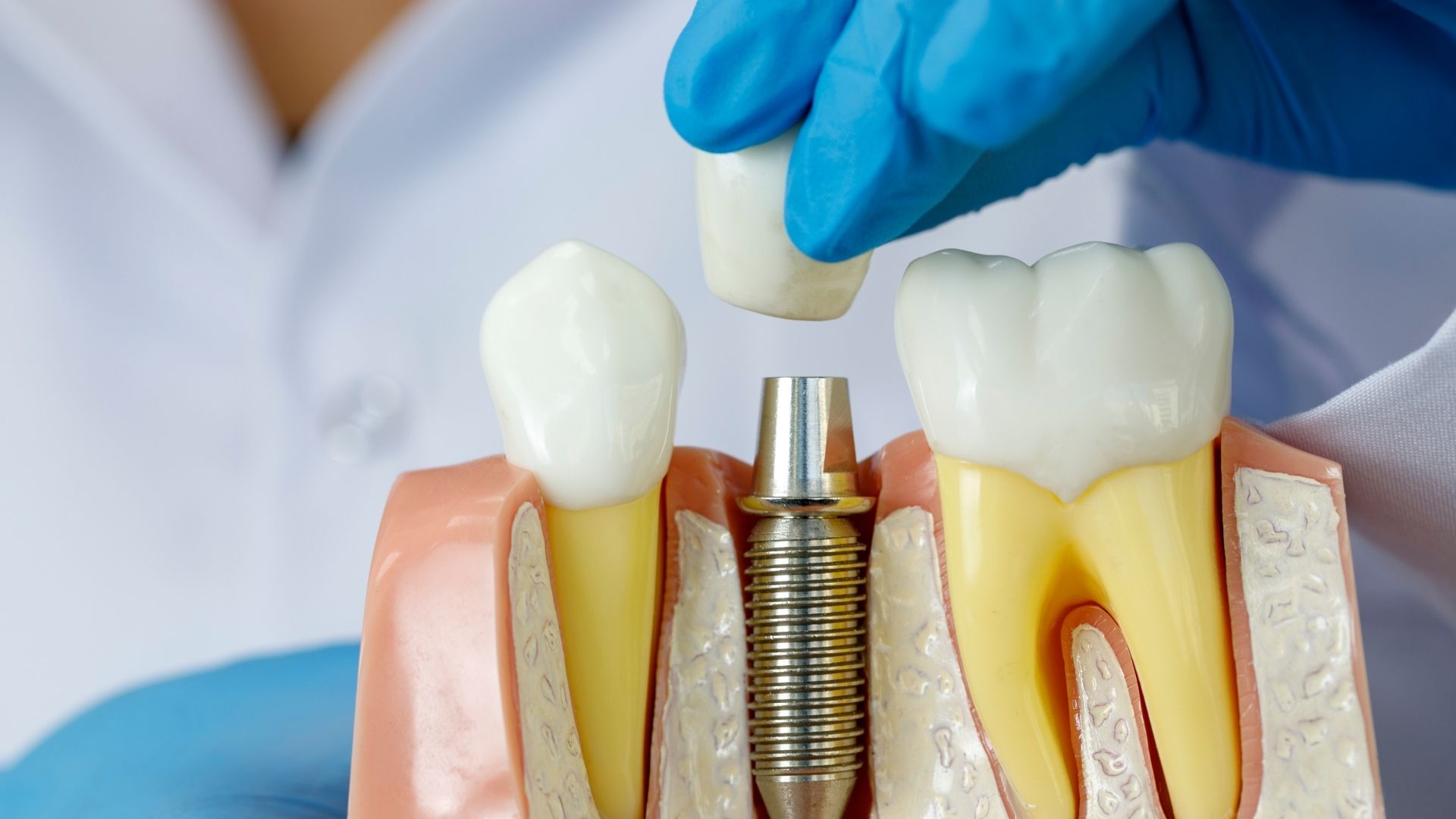 implant dentar ce inseamna