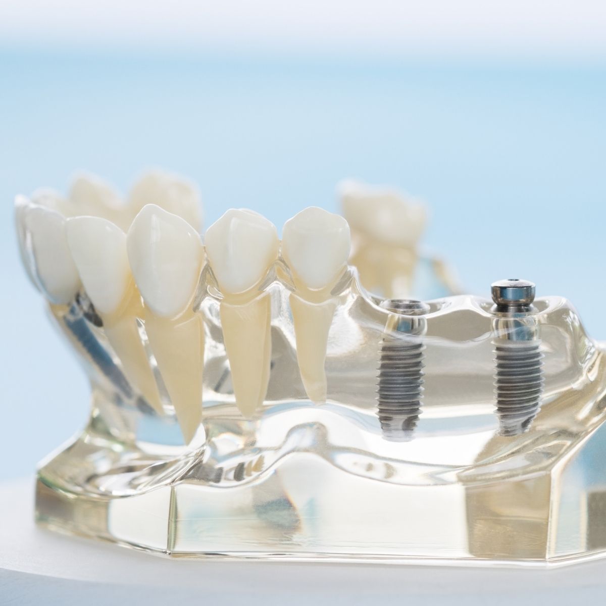 implant dentar ieftin Bucuresti