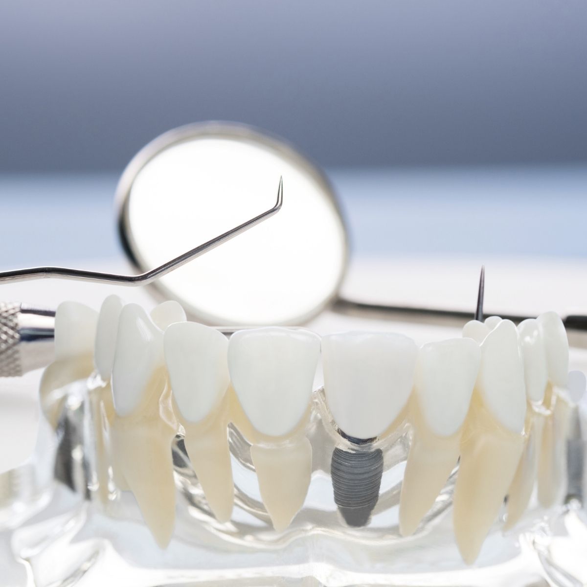 implant dentar ieftin Bucuresti 2021