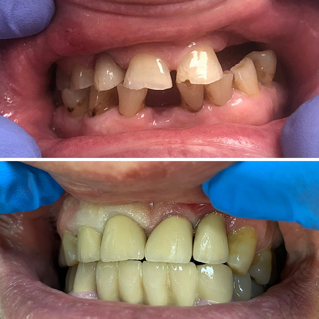 pret implant dentar