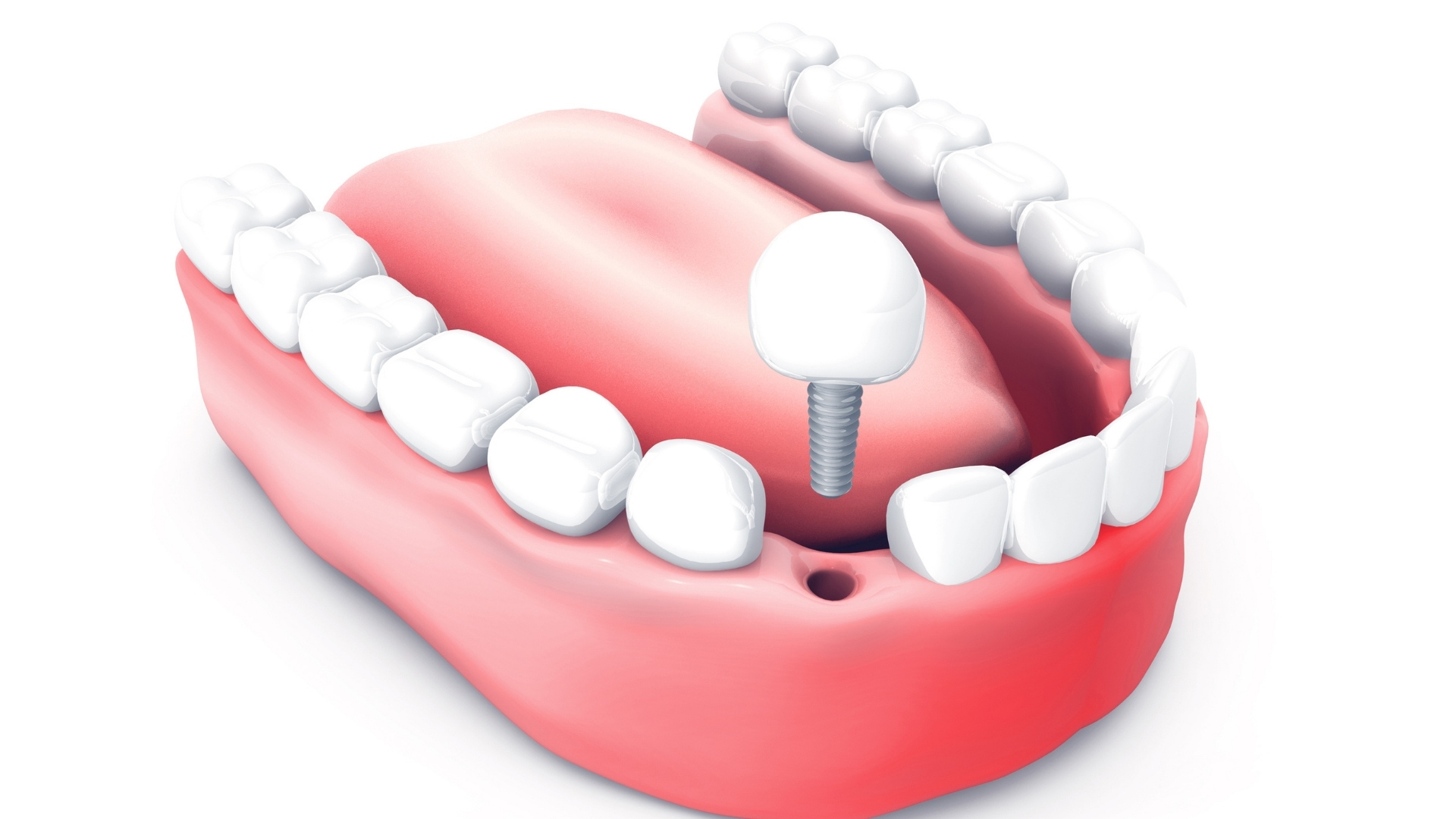 inserare implant dentar