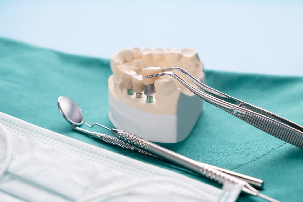intretinere implant dentar