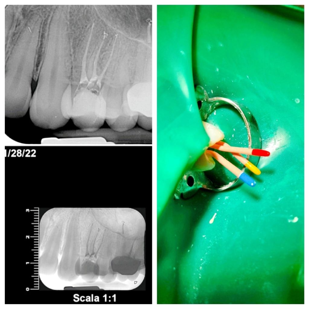 tratament endodontic