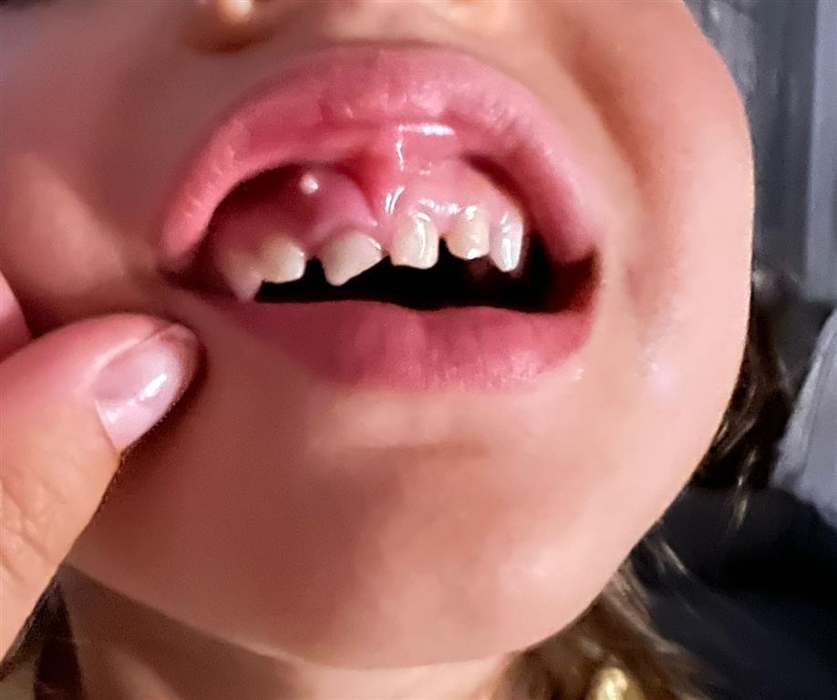 abces dentar la copii