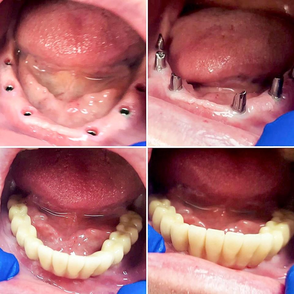 implant dentar dupa extractie